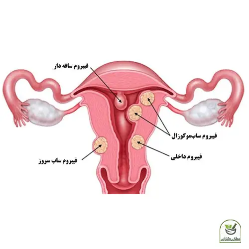 عکس آناتومی رحم و اجزای آن و مشکلات فیبرم برای وبلاگ مشکلات جنسی زنان