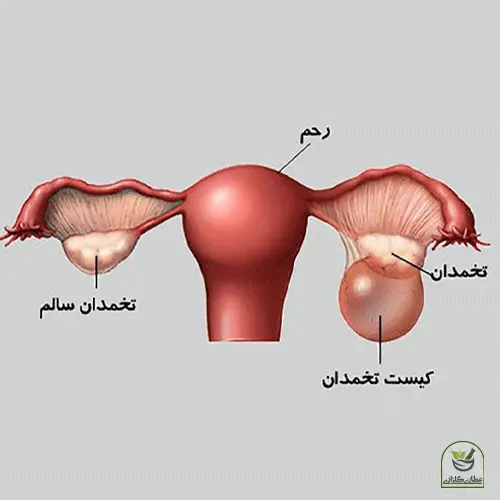 عکس سه بعدی رحم و مشکل کیست تخمدان