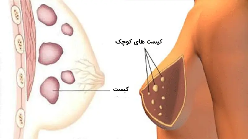 تصویری از یک سینه با کیست های بزرگ در طرف چپ و یک سینه با کیست های کوچک تر در سمت راست