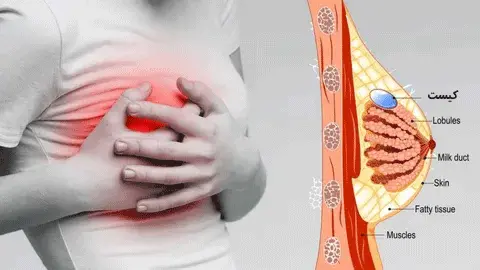 تصویری از یک بدن در سمت چپ که سینه خود را بخاطر درد گرفته است و نمایش گرافیکی از سینه در راست تصویر که اجزای آن مشخص شده و کیست سینه را در آن نشان می دهد.
