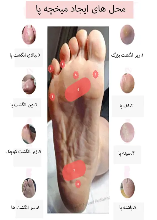 محل های میخچه پا
